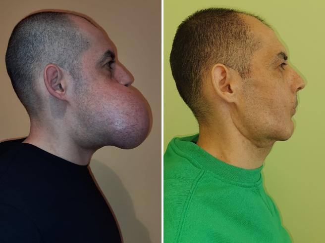 Une tumeur pesant un kilo et quatre cents grammes a été retirée du visage d’un homme de 38 ans