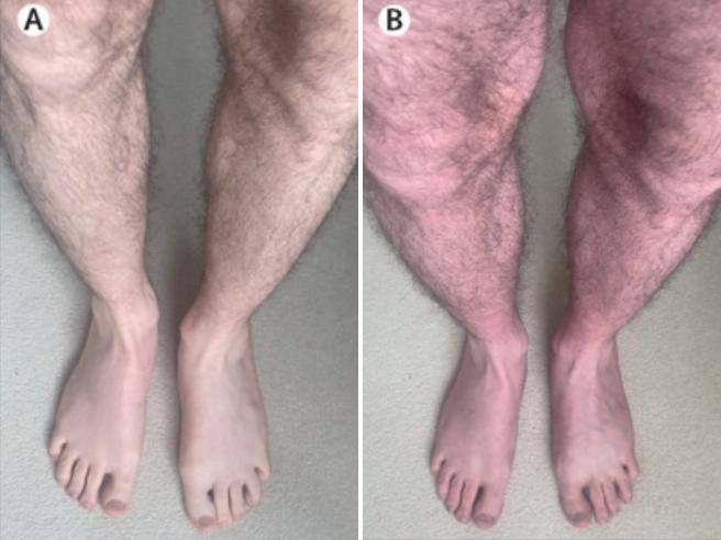 L’étrange « syndrome » des jambes bleues (c’est un symptôme du Long Covid)