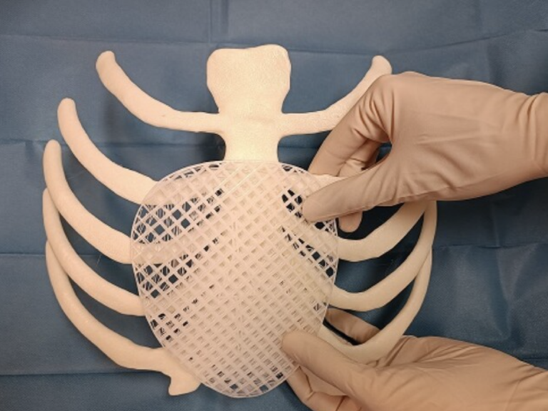 Prothèse résorbable imprimée en 3D, première opération en Europe chez Meyer