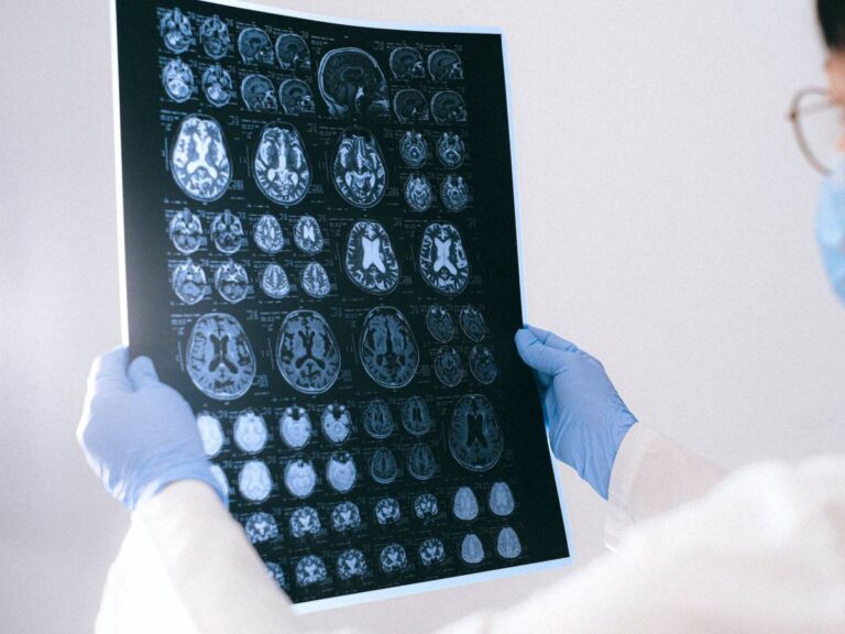 Alzheimer, un gène pourrait protéger le cerveau : l'étude