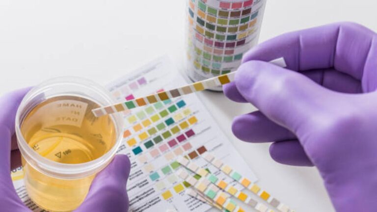 Test d'urine pour les patients atteints d'un cancer de la vessie : peut-il être utilisé comme contrôle à la place de la cystoscopie ?