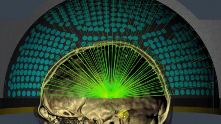 Thérapie Sonodynamique : un nouveau traitement contre le glioblastome cérébral est testé à l'Institut Besta de Milan